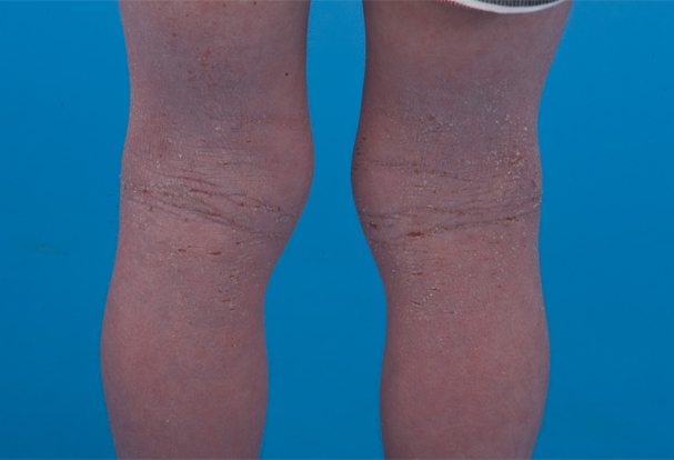 Eczema in the bend behind the knee — red, inflamed, fuzzy-edged