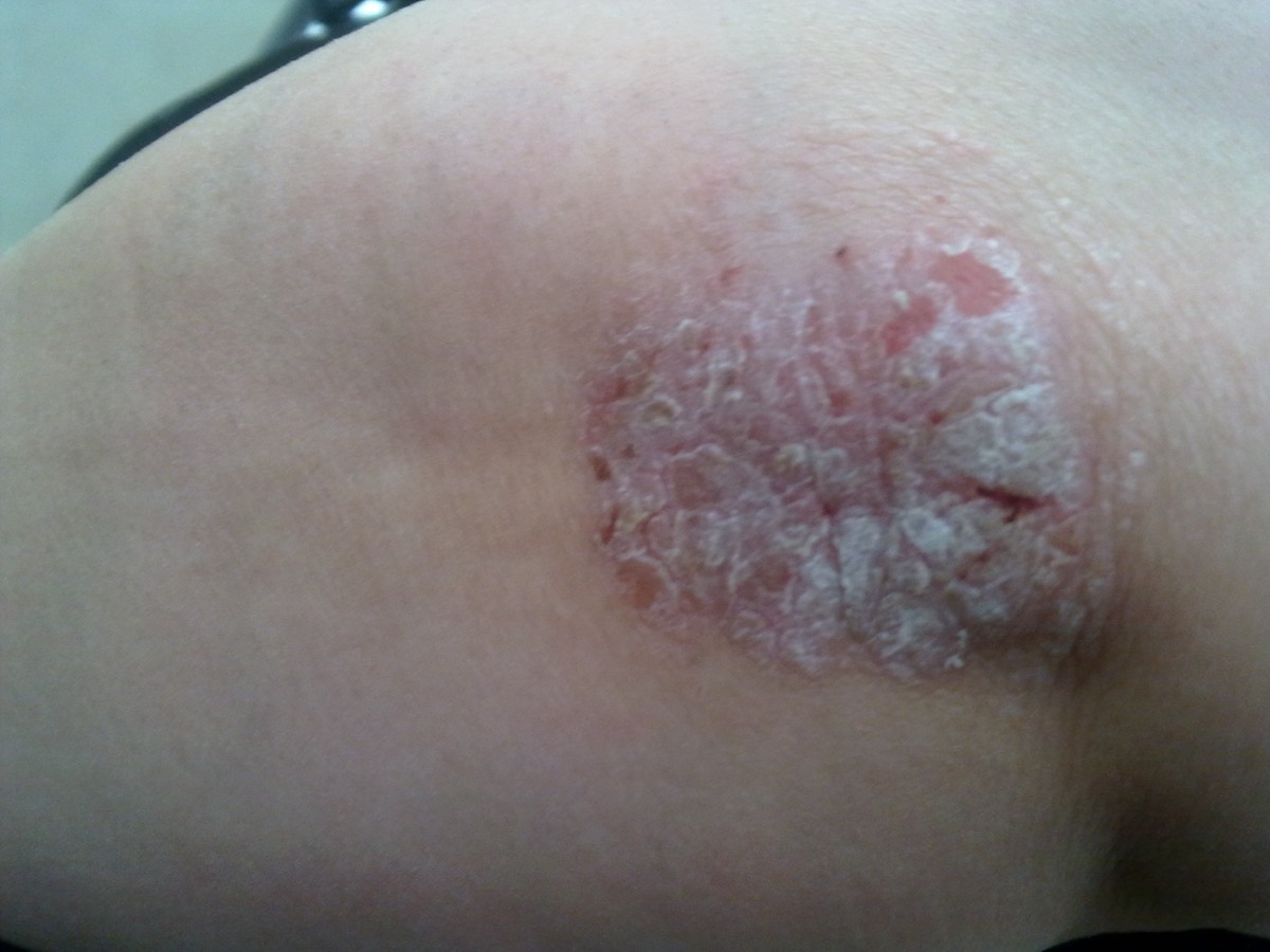 Plaque psoriasis on the elbow — dry, thick, silvery scale