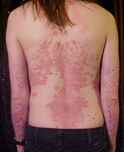 Thick silvery plaque psoriasis on the back